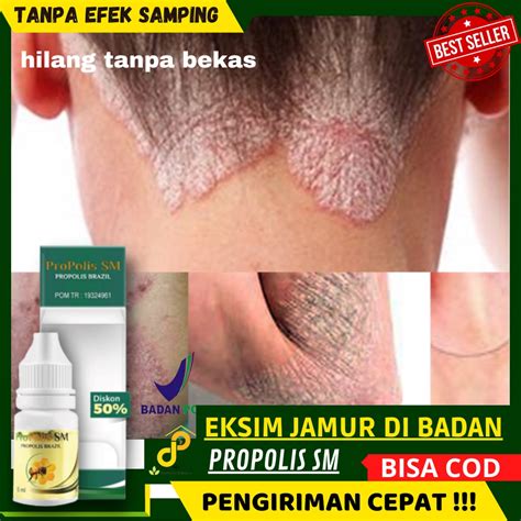 Jual Cara Mudah Mengobati Gatel Di Badan Kurap Eksim Dan Jamur Di