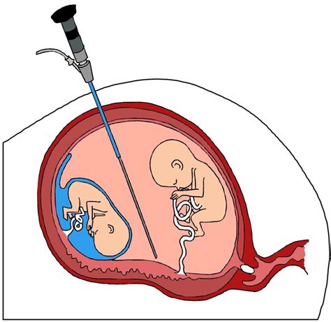 Tratamiento del Síndrome de Transfusión feto fetal Menudos valientes