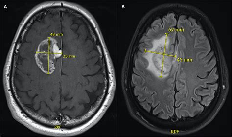 Frontiers Assessment Of Pre Operative Measurements Of Tumor Size By