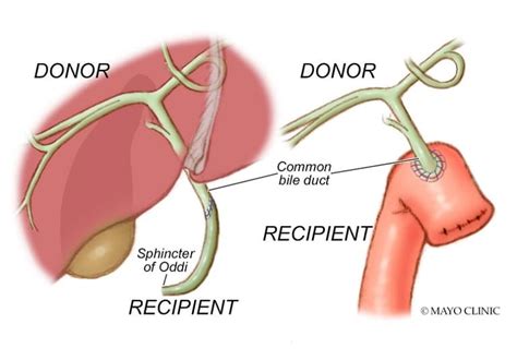 Roux En Y Biliary Anastomosis Hot Sex Picture