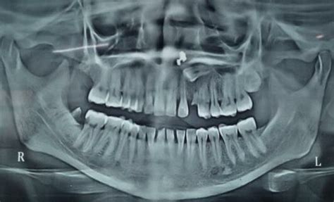 Radiographic investigations (Pre Op OPG) | Download Scientific Diagram