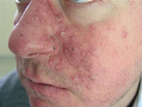 Diseases Of The Sebaceous Glands Acne Cystic Picture Hellenic