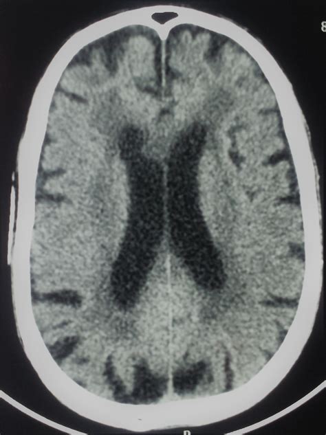 Lentiform Nucleus