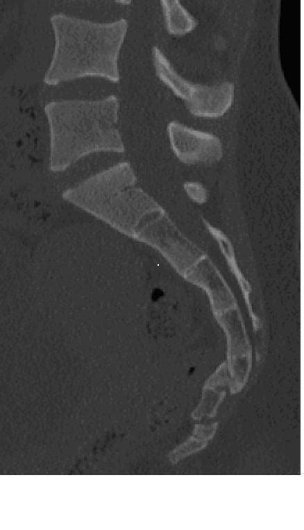 Coccyx Fracture