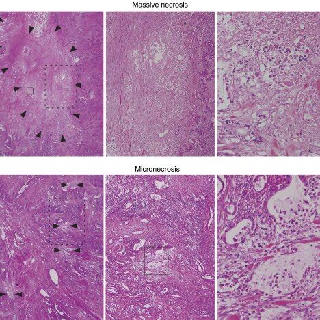 Representative Histology Of Massive Necrosis Upper Columns And