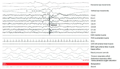 Characteristic Polysomnographic Presentation Of A Neck Myoclonus