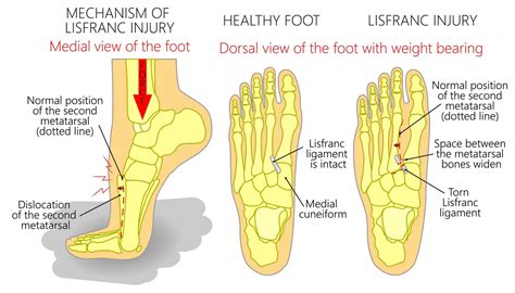 Midfoot Sprain: Symptoms and Treatment explained by a Specialist