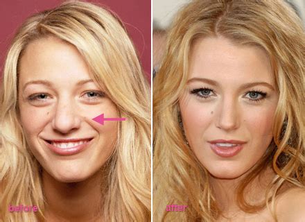 Blake Lively Plastic Surgery Before And After Photos