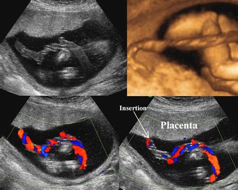 Velamentous Cord Insertion Ultrasound