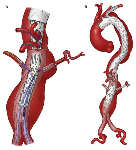 Editors Choice Multicentre Outcomes Of Redo Fenestratedbranched Endovascular Aneurysm Repair