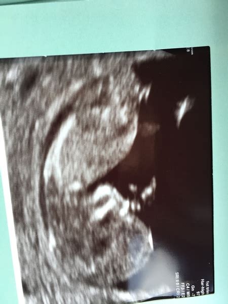 Gender Guesses Please Week Scan Mumsnet