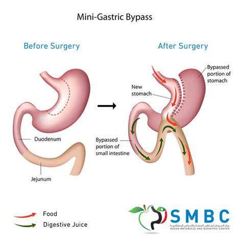 Mini Gastric Bypass Smbc