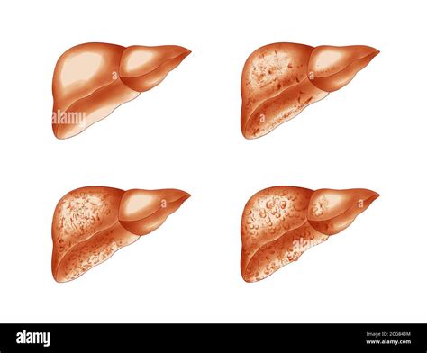 Anatomical Illustrations Of Liver Disease Stock Photo Alamy