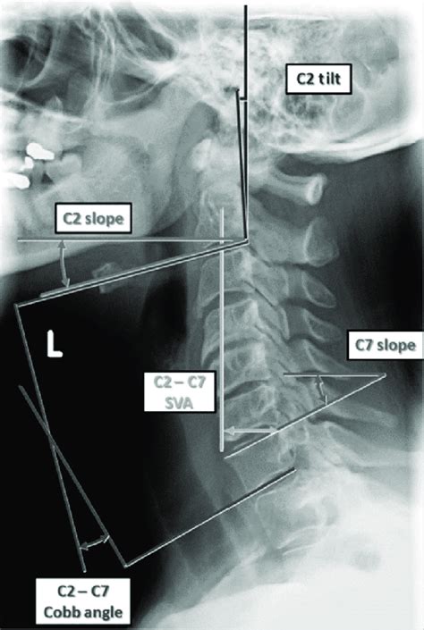 Cervical Spine Alignment