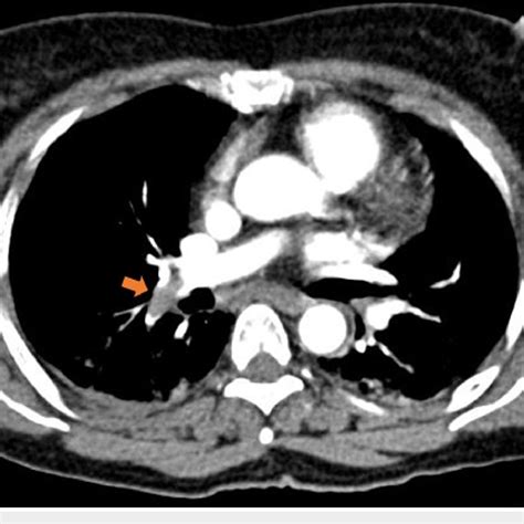 Axial Section Image Of The Contrast Enhanced Computed Tomography Cect