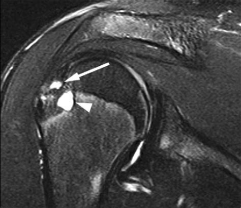 Rotator Cuff Mri Images