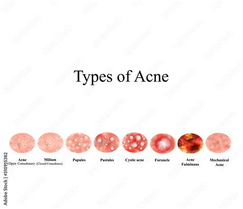 Types Of Acne Skin Inflammation Pimples Boils Whitehead Closed