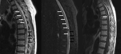 Preoperative Magnetic Resonance Mr Images Sagittal T2 And