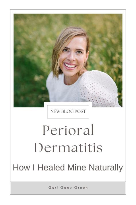 How I Was Able To Heal My Perioral Dermatitis Naturally Artofit