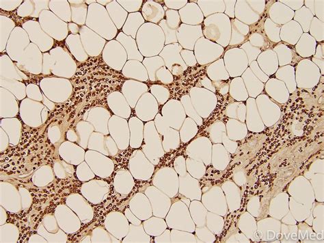 Invasive Lobular Carcinoma Of Breast