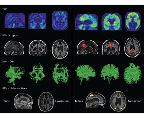 John Libbey Eurotext Revue de neuropsychologie Les états de