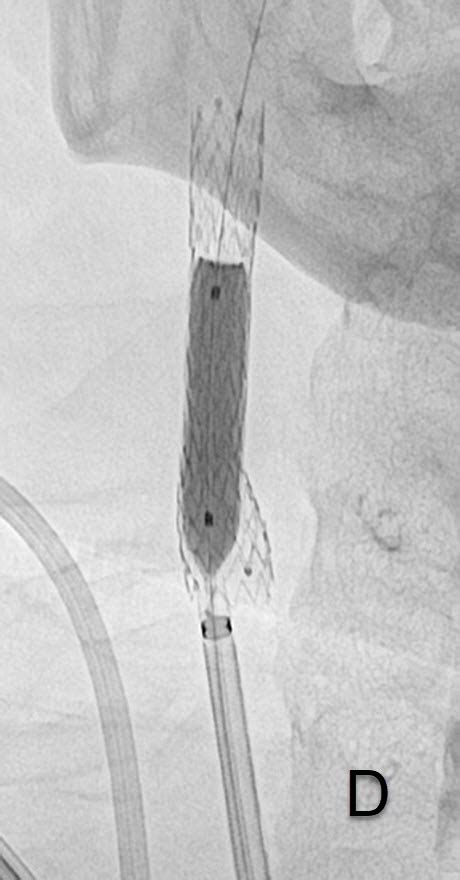 Stenting der Halsgefässe Universitätsinstitut für Diagnostische und