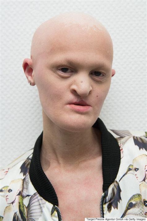 Melanie Gaydos Model With Ectodermal Dysplasia Is Making Waves In The