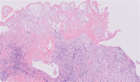 Skin Biopsy Of The Abdominal Lesion Showing Epidermal Necrosis And A