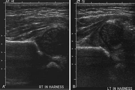 Developmental Dysplasia Of The Hip Ultrasound