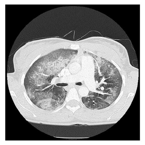 Contrast Enhanced Computed Tomography Demonstrating Extensive Diffuse