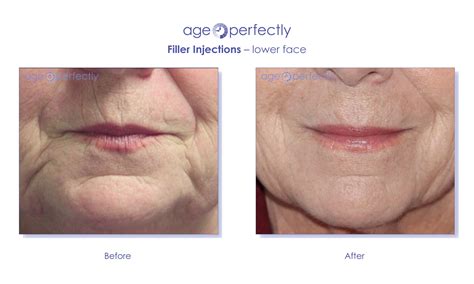 filler  face age perfectly