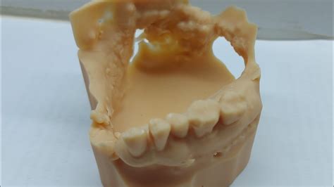 Maxillofacial Prostheses Definitive Obturator YouTube