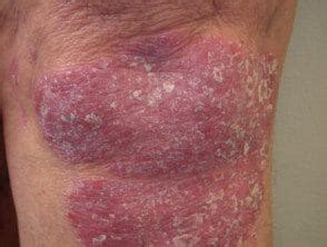 Imágenes de psoriasis en placa crónica Hoogstra Centros Medicos