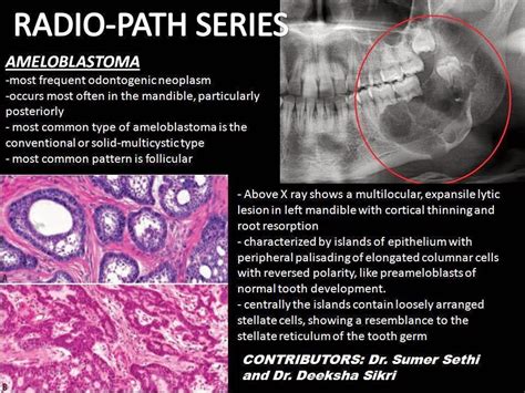 Ameloblastoma-Radio-Path Series - Sumer's Radiology Blog