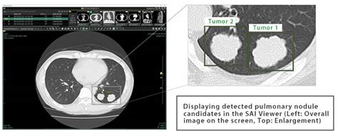 Fujifilm S New AI Based Technology For Lung Nodule Detection Approved