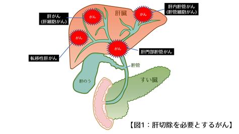 腹腔鏡下肝切除｜肝胆膵・移植班－慶應義塾大学病院 一般・消化器外科