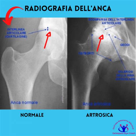 Artrosi Dellanca Coxartrosi Sintomi Rimedi Esercizi Osteopata