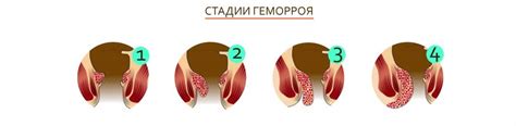 Геморрой - лечение геморроя в Центре проктологии и малоинвазивной ...