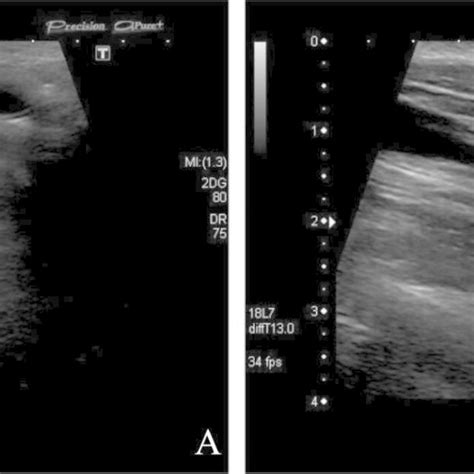 Ultrasound Of The Thyroid Gland Ultrasound Prior To Sclerotherapy One