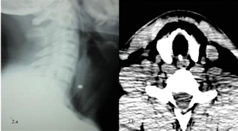 A X Ray Soft Tissue Neck Lateral View Showing The Radio Opaque Foreign Download Scientific