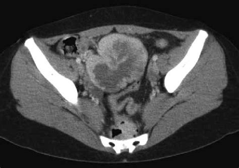 Axial Ct Demonstrating A Large Mesenteric Pelvic Mass With Download Scientific Diagram