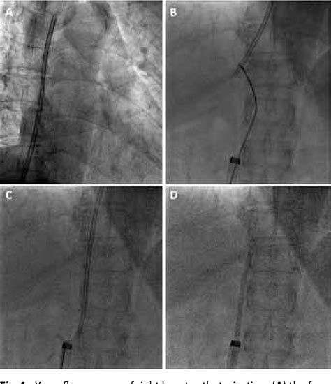 Figure 1 from Removal of a Fractured Tunneled Cuffed Catheter from the Right Atrium and Inferior ...