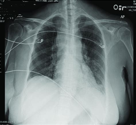 A Bulky Cervical Lymphadenopathy B Mediastinal Hilar And Download Scientific Diagram