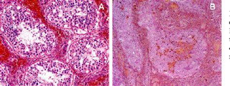 Figure 2 From Acute Epididymoorchitis Acute Orchitis Abscess