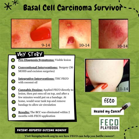 Basal Cell Carcinoma PRO Hub - Cancer Playbook