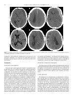 PDF Hematoma subdural crónico Hematoma subdural cronico Chronic