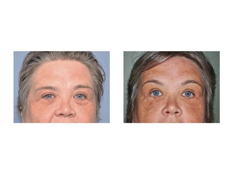 Case Study Upper And Lower Blepharoplasties With Endoscopic Browlift