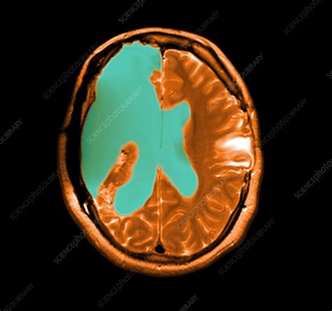 MRI shows near total hemispherectomy - Stock Image - C003/4764 ...