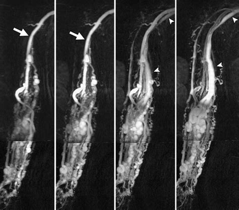 Mr Imaging Of Soft Tissue Vascular Malformations Diagnosis Classification And Therapy Follow