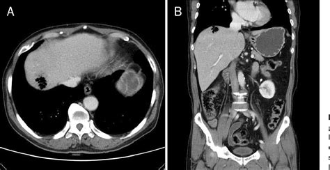 Figure 1 From A Case Of Clostridium Liver Abscess With Sepsis